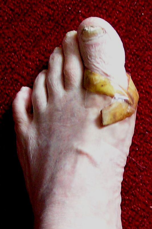 Лечение банановой шкуркой косточек на ногах
